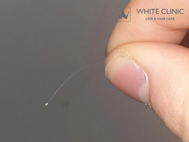 rụng tóc chân trắng