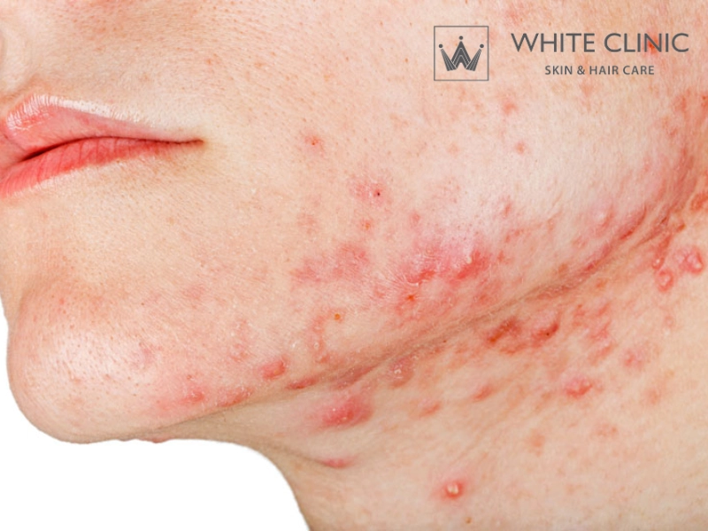 các vùng bị mụn trên mặt và nguyên nhân