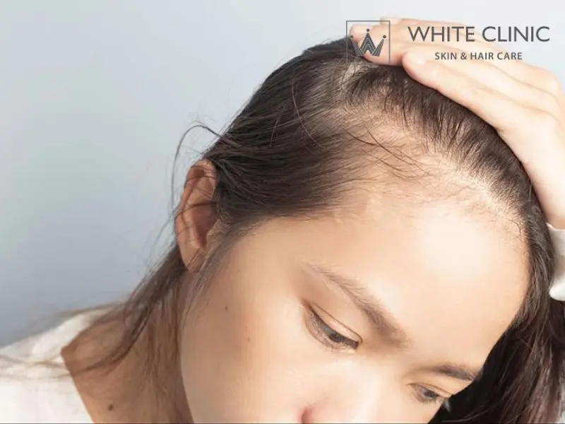 thiếu sắt có rụng tóc không