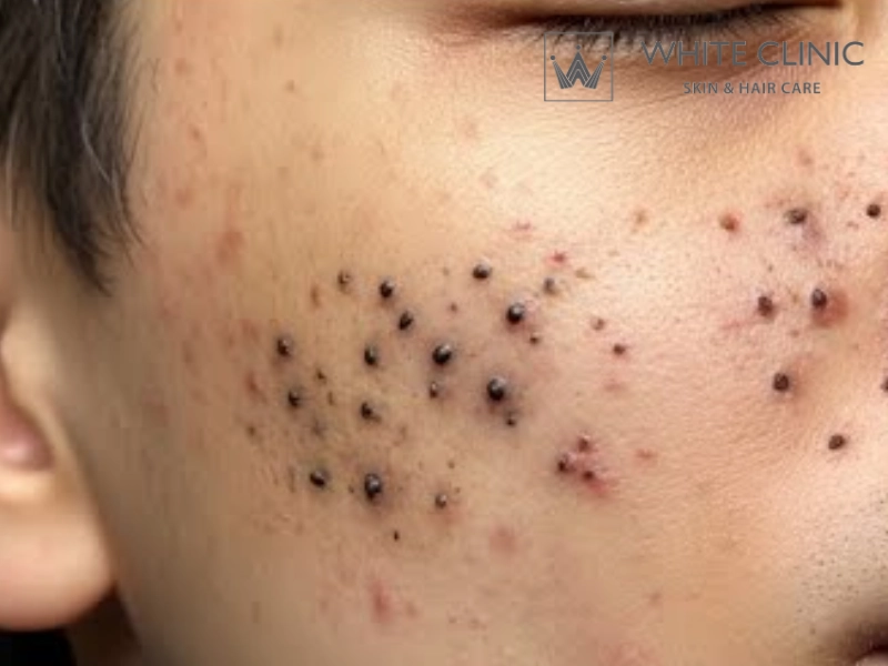 thuốc trị sẹo trái rạ