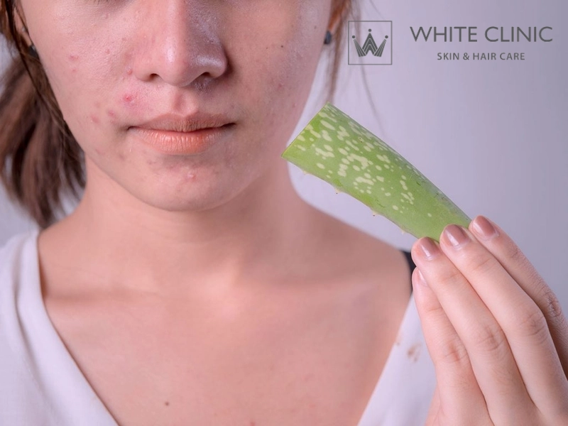 Tại sao nhiều người bị kích ứng, đỏ rát khi đắp nha đam tại nhà?