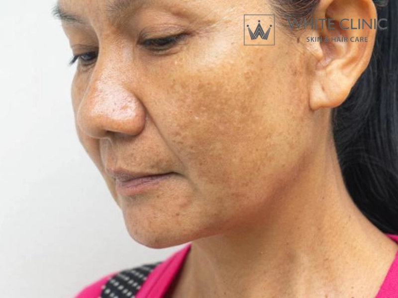 điều trị nám chân sâu