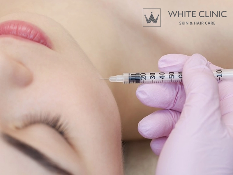 các loại filler được cấp phép