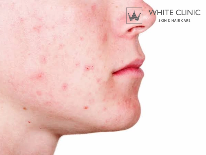 thâm mụn có tự hết không thâm mụn có tự hết không