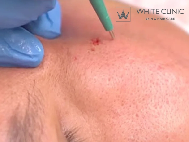 trị sẹo đáy nhọn