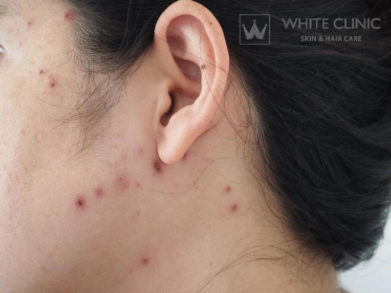 trị sẹo lõm thủy đậu trị sẹo lõm thủy đậu