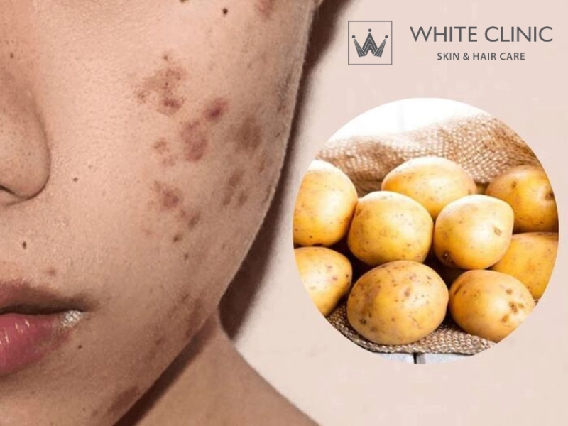 trị mụn bằng khoai tây