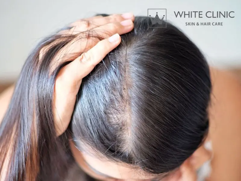 tóc mỏng tóc mỏng