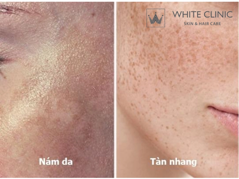 nguyên nhân nám
