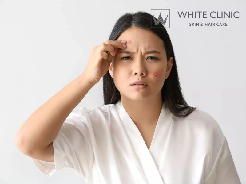 Rủi ro biến chứng và cách chăm sóc da phòng ngừa thâm Rủi ro biến chứng và cách chăm sóc da phòng ngừa thâm