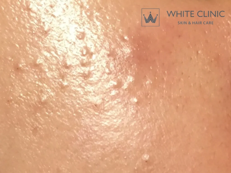 trị mụn ẩn cho da dầu