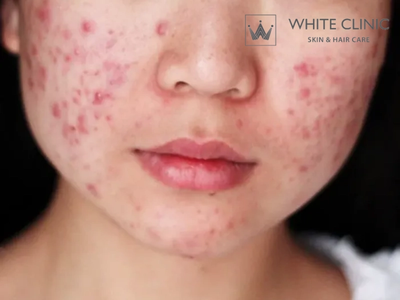 Nguyên Nhân Nổi Mụn Ở Má Và Phương Pháp Điều Trị Hiệu Quả 