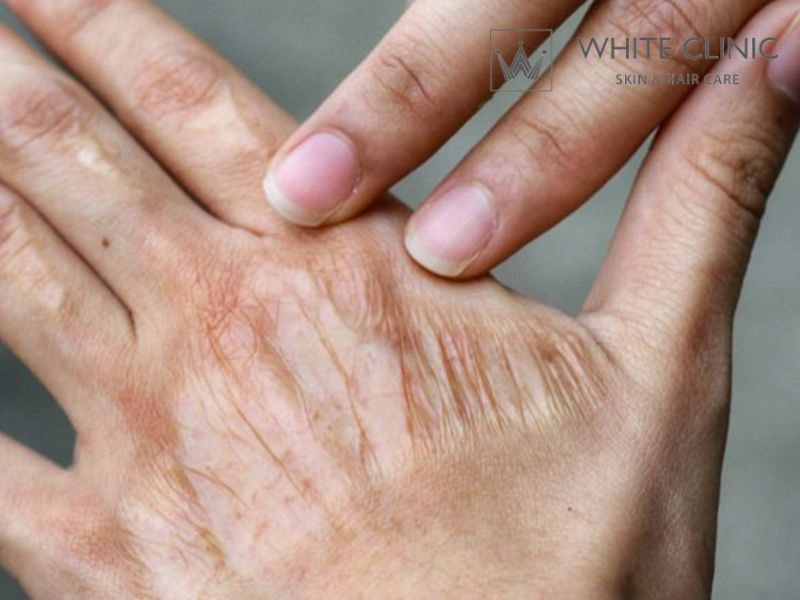 sẹo co rút sẹo co rút