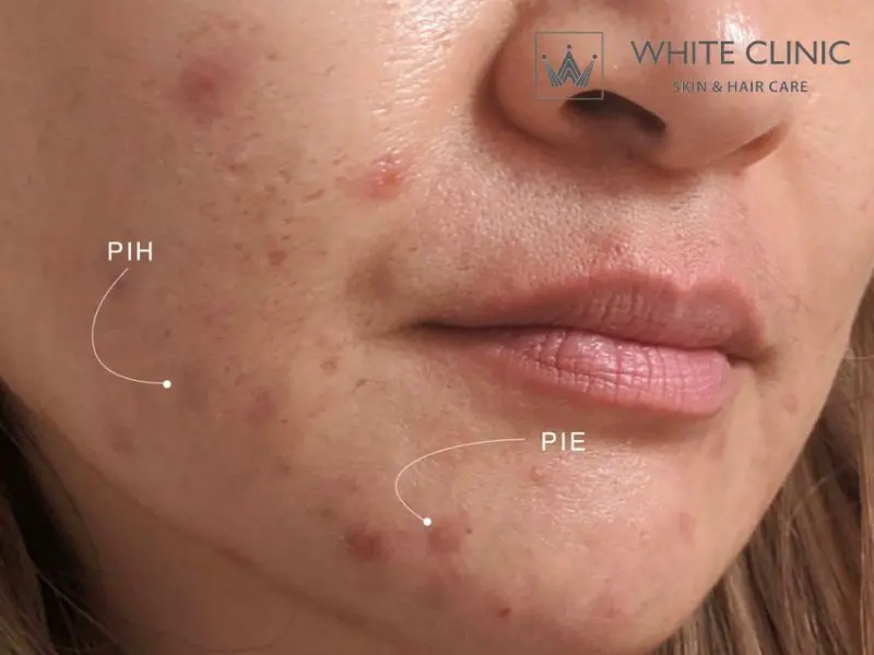 tăng sắc tố sau viêm tăng sắc tố sau viêm