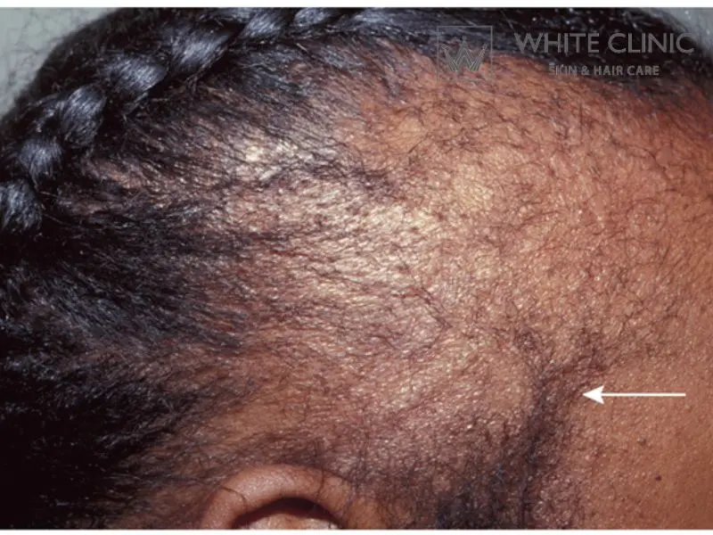 rụng tóc không sẹo