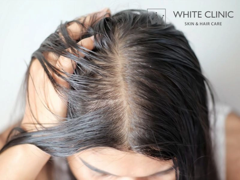 da đầu nhờn rụng tóc da đầu nhờn rụng tóc