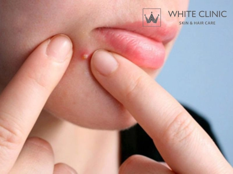 Những sai lầm nghiêm trọng cần tránh khi tự điều trị mụn tại nhà