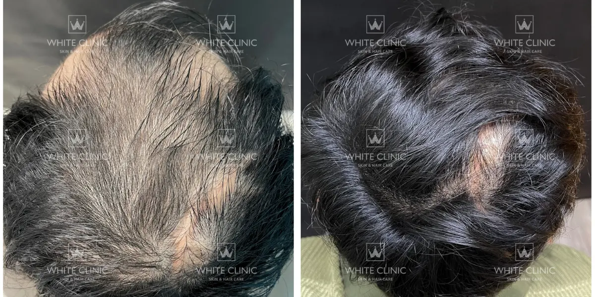 Rụng tóc kiểu hói ở nam