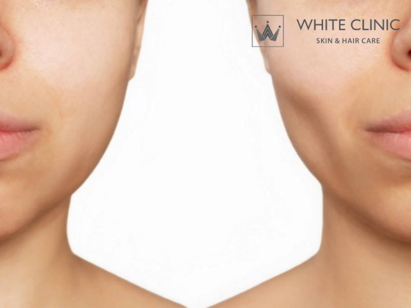 tiêm botox có bị đơ không