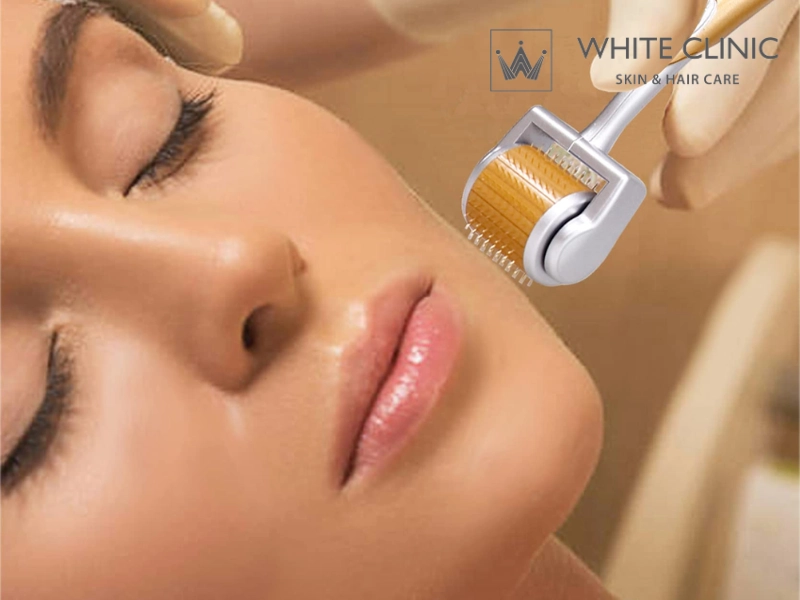 Lăn kim đơn thuần hay cần kết hợp phương pháp khác? Lăn kim đơn thuần hay cần kết hợp phương pháp khác?