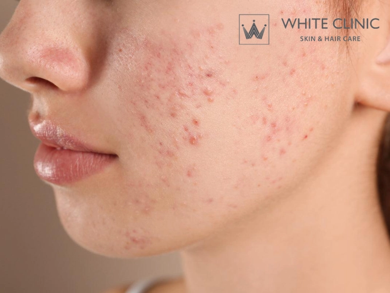bột nghệ trị mụn thâm
