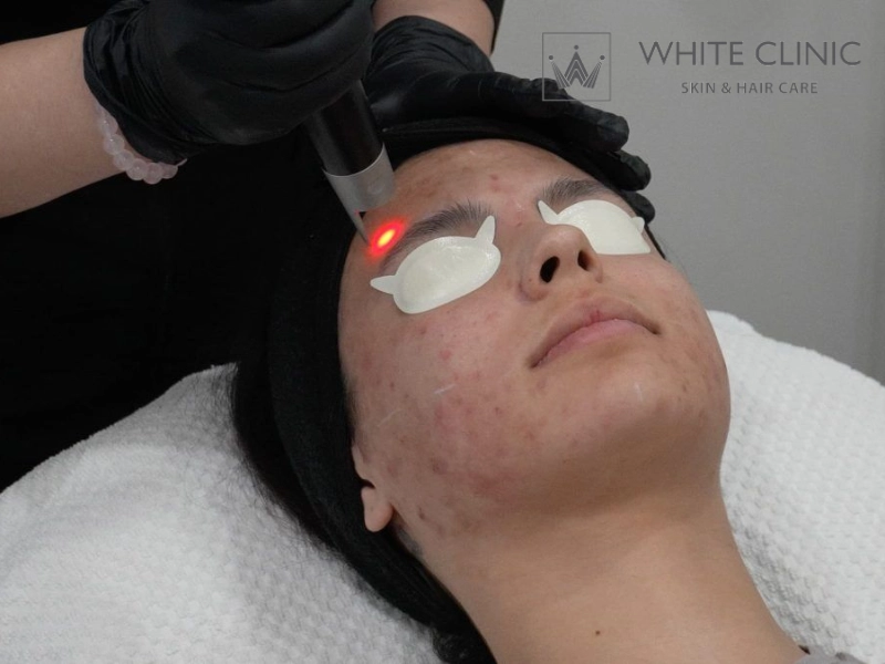 Quy trình cắt đáy sẹo an toàn và kiểm soát rủi ro tại White Clinic Quy trình cắt đáy sẹo an toàn và kiểm soát rủi ro tại White Clinic