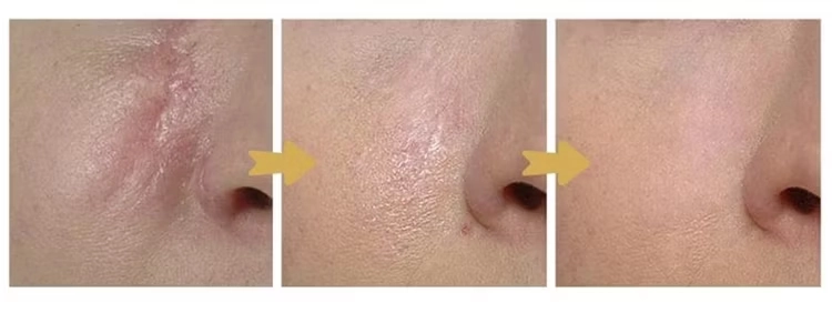 ultra-shine-meso ultra-shine-meso