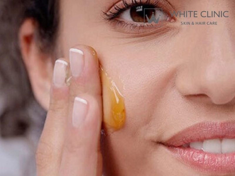 trị mụn bằng mật ong