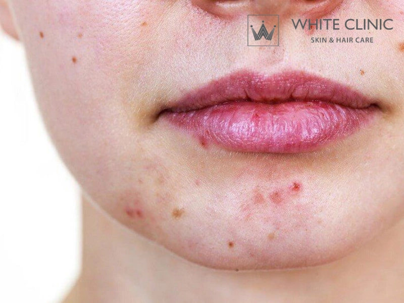 các vùng bị mụn trên mặt và nguyên nhân