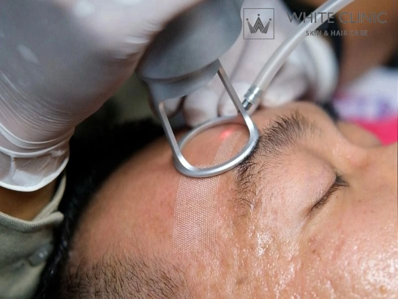 phương pháp trị sẹo rỗ phương pháp trị sẹo rỗ