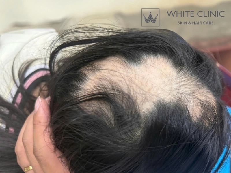 da đầu nhạy cảm da đầu nhạy cảm