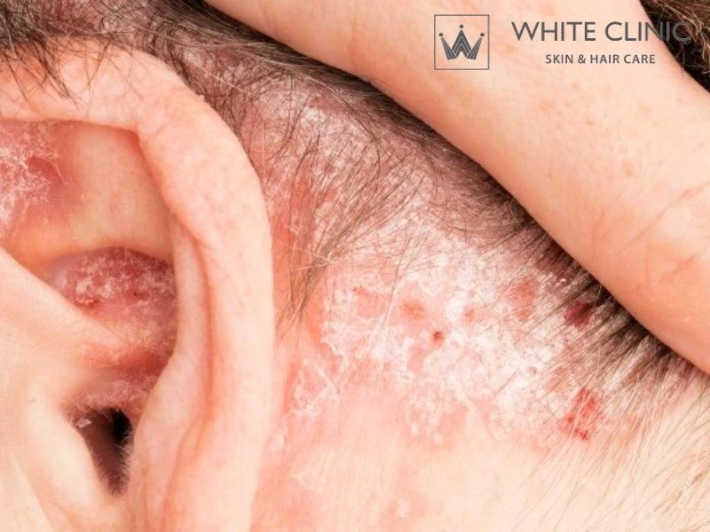 Tìm Hiểu Cách Trị Ngứa Da Đầu Hiệu Quả Và Phòng Ngừa Toàn Diện