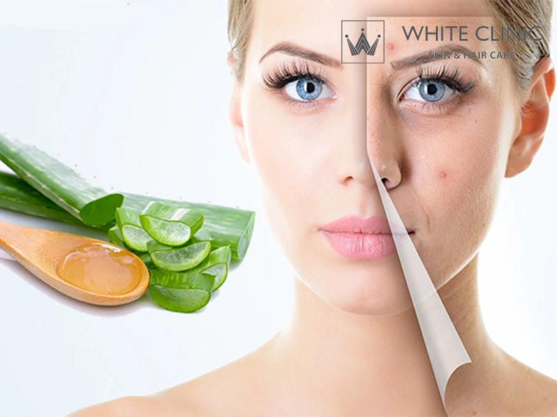 cách trị mụn băng nha đam