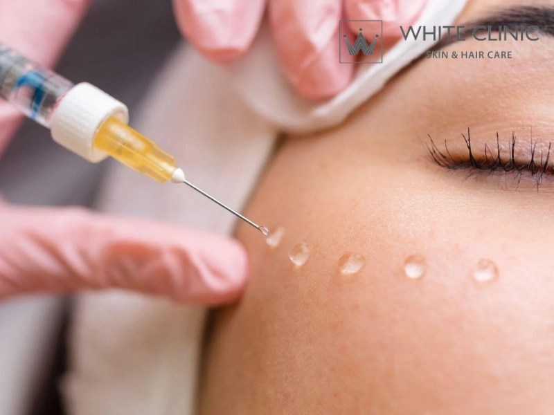 So sánh tiêm filler làm đầy sẹo lõm với Laser và Lăn kim: Lựa chọn nào tối ưu? So sánh tiêm filler làm đầy sẹo lõm với Laser và Lăn kim: Lựa chọn nào tối ưu?