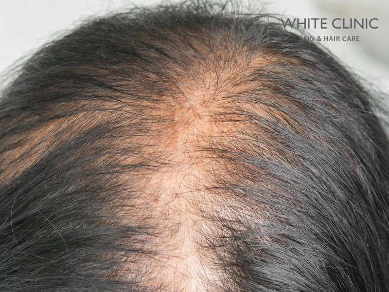 rụng tóc lan tỏa rụng tóc lan tỏa