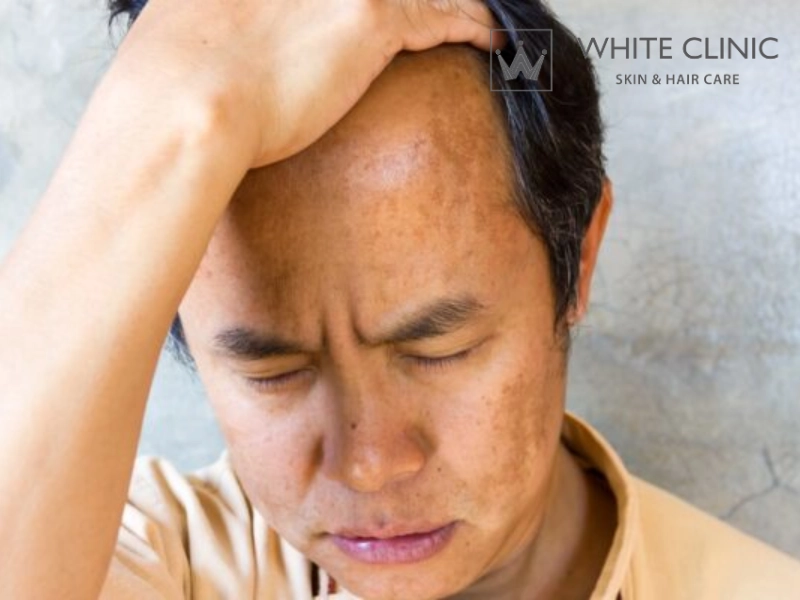 nguyên nhân bị nám da mặt ở nam giới