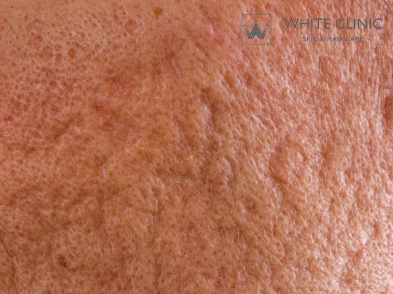 tiêm filler làm đầy sẹo lõm tiêm filler làm đầy sẹo lõm