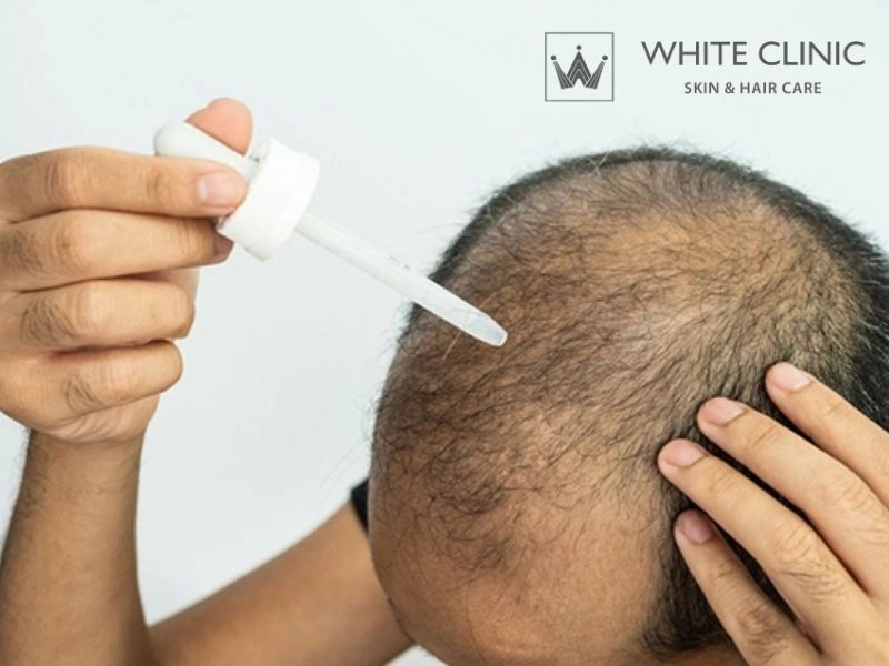 Dùng Minoxidil bị rụng tóc: Dấu hiệu hiệu quả hay cảnh báo nguy hiểm?