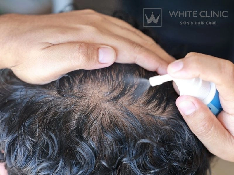 cách dùng minoxidil