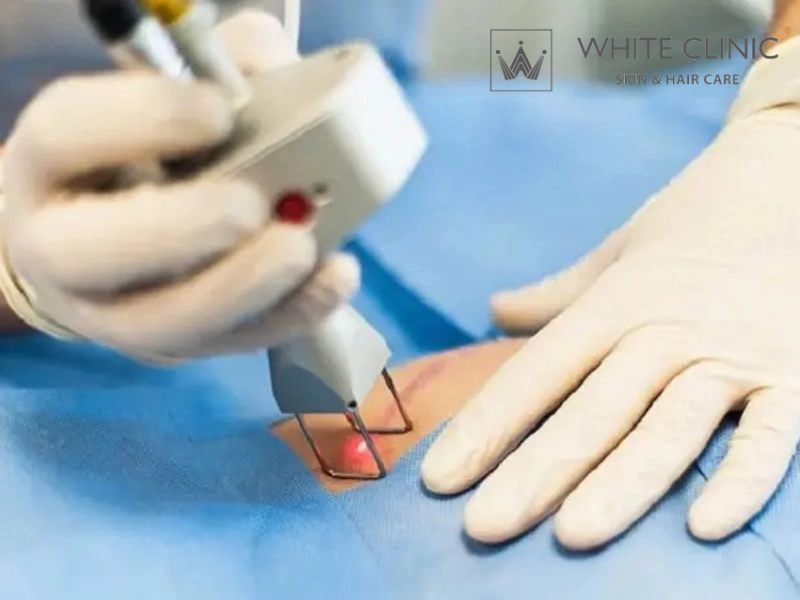 Xây dựng phác đồ cá nhân hóa điều trị sẹo co rút tại White Clinic Xây dựng phác đồ cá nhân hóa điều trị sẹo co rút tại White Clinic