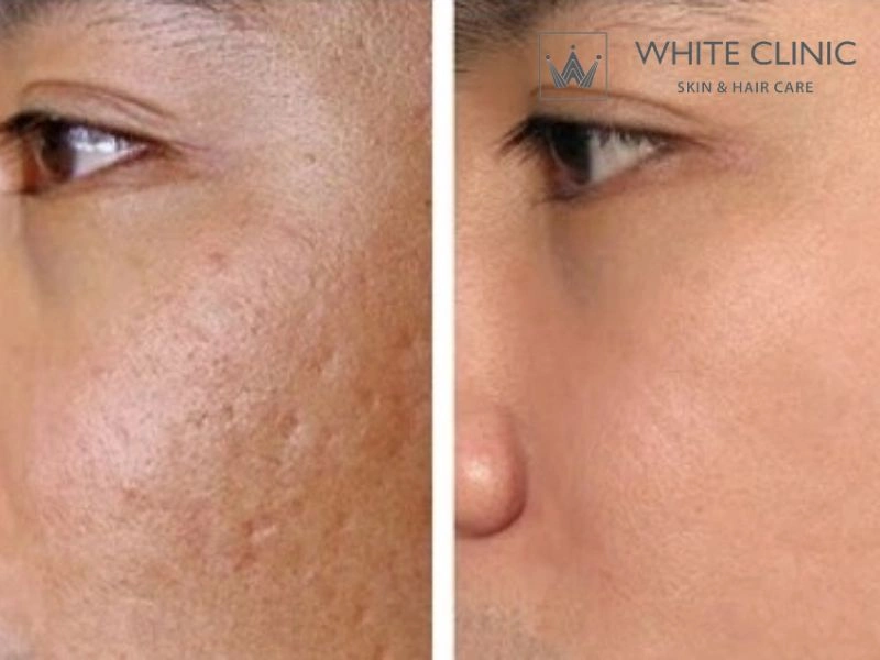 Quản lý kỳ vọng và rủi ro sau điều trị sẹo rỗ