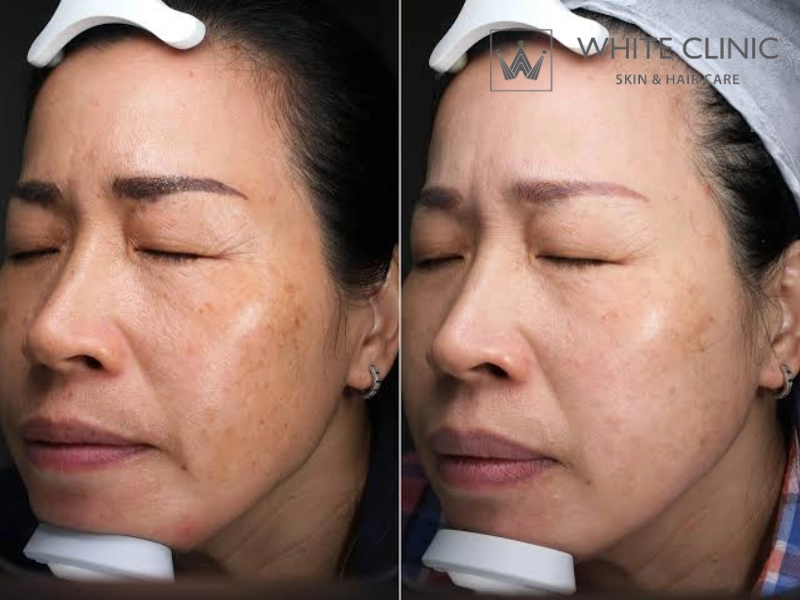 trị nám tàn nhang tại nhà
