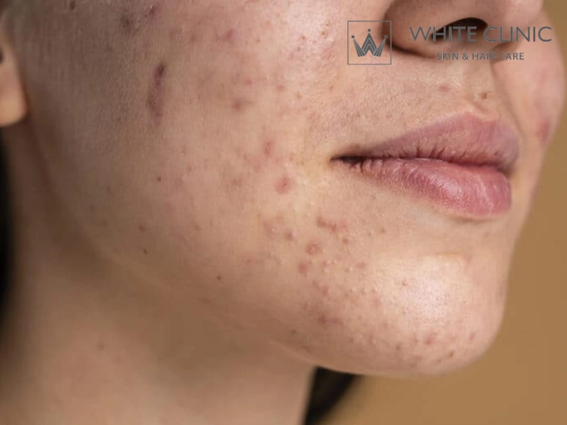 tăng sắc tố sau viêm da có hết không