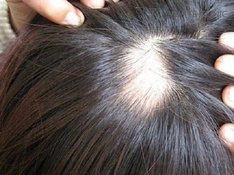 rụng tóc từng mảng có mọc lại được không rụng tóc từng mảng có mọc lại được không