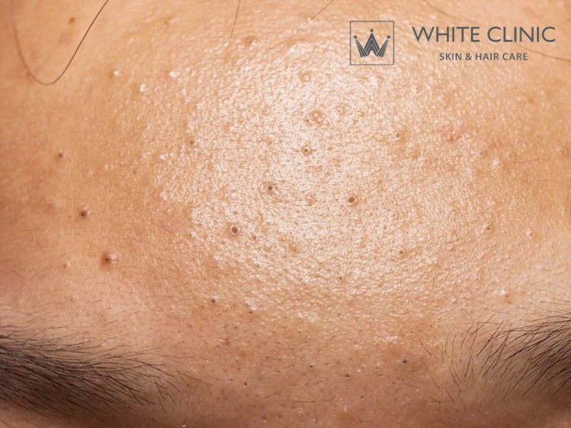 trị mụn ẩn cho da dầu