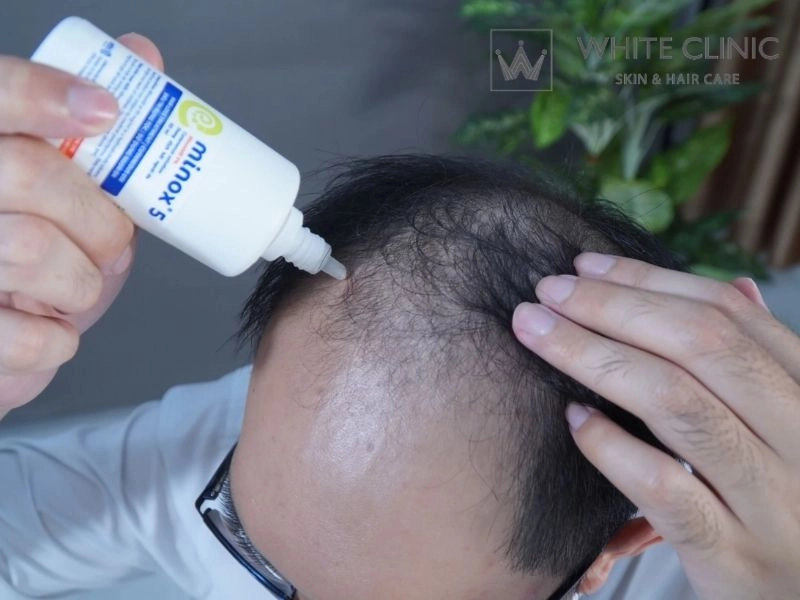 Cách dùng Minoxidil đúng liều lượng và tần suất để điều trị rụng tóc an toàn
