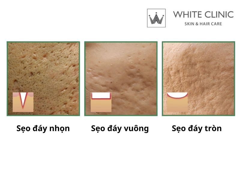 Quy trình đánh giá nền sẹo và lên phác đồ tại White Clinic