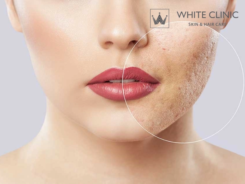 trị sẹo lâu năm