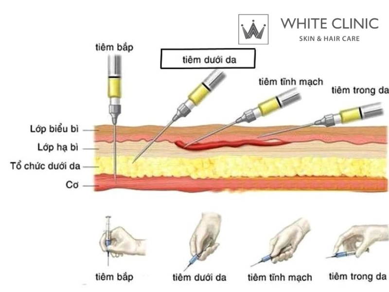 kỹ thuật tiêm filler kỹ thuật tiêm filler