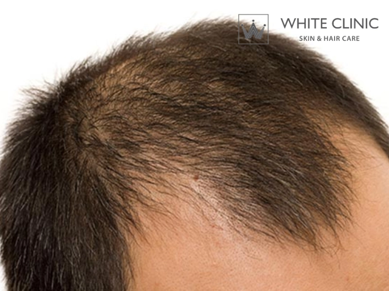 Rụng tóc do androgen